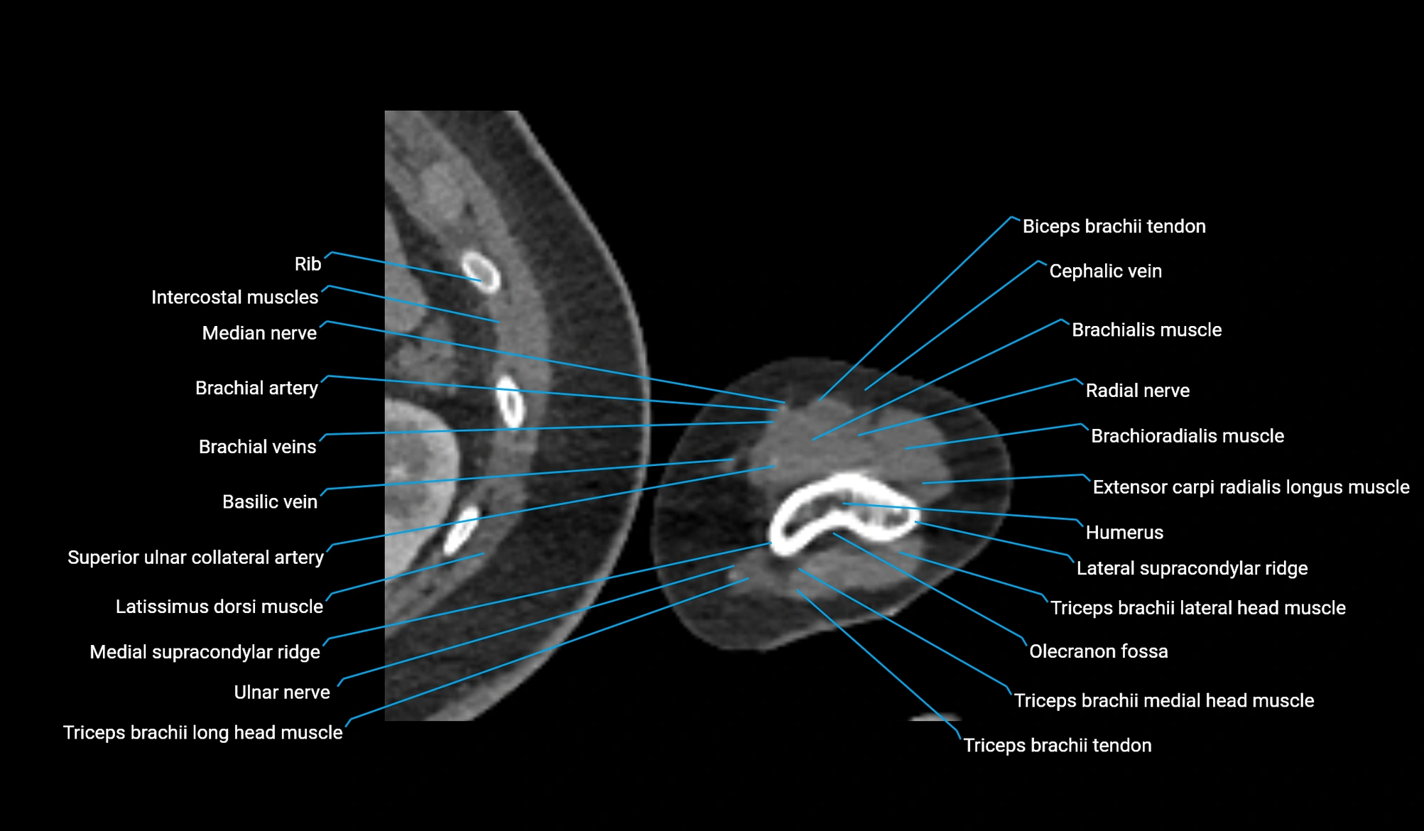 CT upper arm axial  cross sectional anatomy labelled radiology image -00364.webp